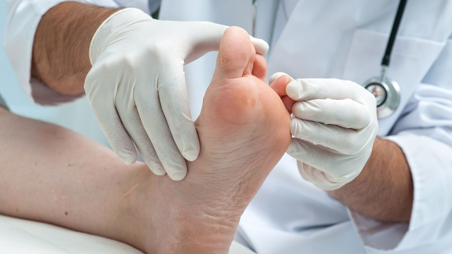 Fußpilz: Diagnose und Behandlung beim Hautarzt  